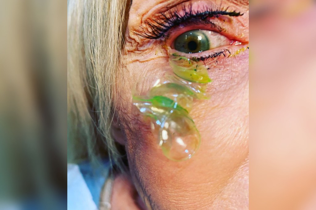 A California doctor has shared a bizarre video of her removing 23 contact lenses from a forgetful patient’s eye.