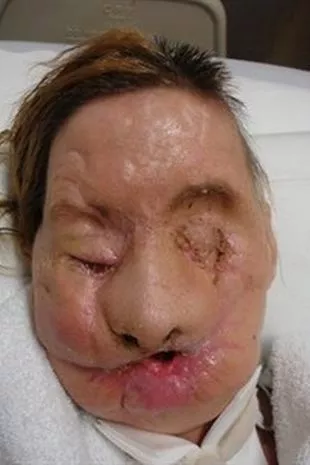 Image of charla nash's face after Travis the chimp had attacked her
