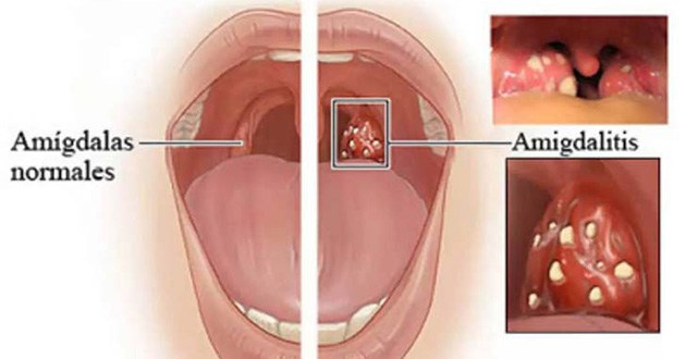 Remedios para aliviar el dolor de garganta y la amigdalitis en solo 4 horas
