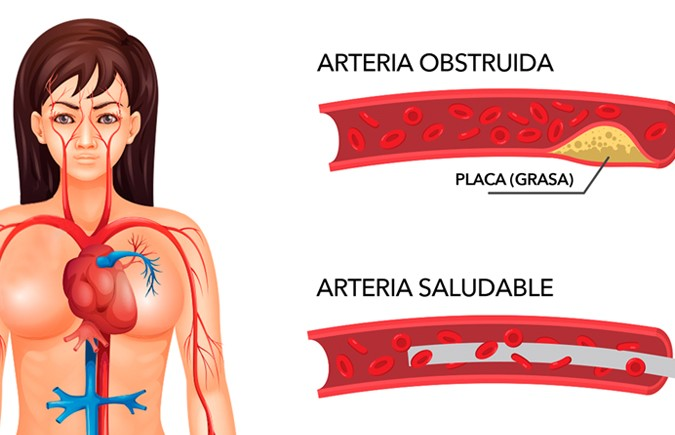 Cómo limpiar las arterias obstruidas naturalmente con sólo tres ingredientes